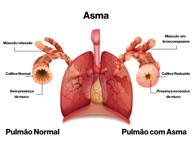 Ilustração da diferença entre um pulmão normal e um pulmão de um portador de Asma