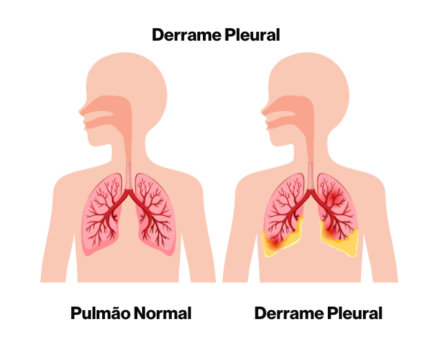 Ilustração da diferença entre um pulmão normal e um pulmão com derrame pleural