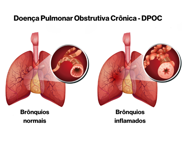 Ilustração da diferença entre um pulmão normal e um pulmão de um portador de DPOC - Doença Pulmonar Obstrutiva Crônica