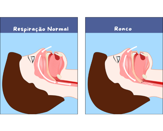 Imagem ilustrativa da garganta demonstrando como acontece o ronco em comparação a respiração normal 