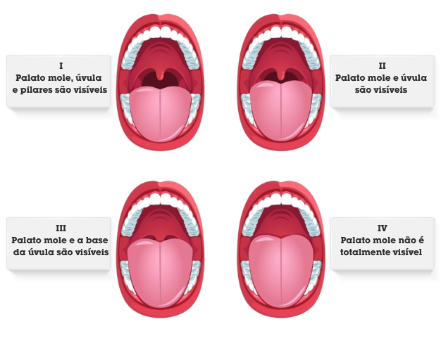 Figura com imagem da boca aberta demonstrando a Escala de Mallampati (EM), que visa avaliar o manejo da via aérea difícil.